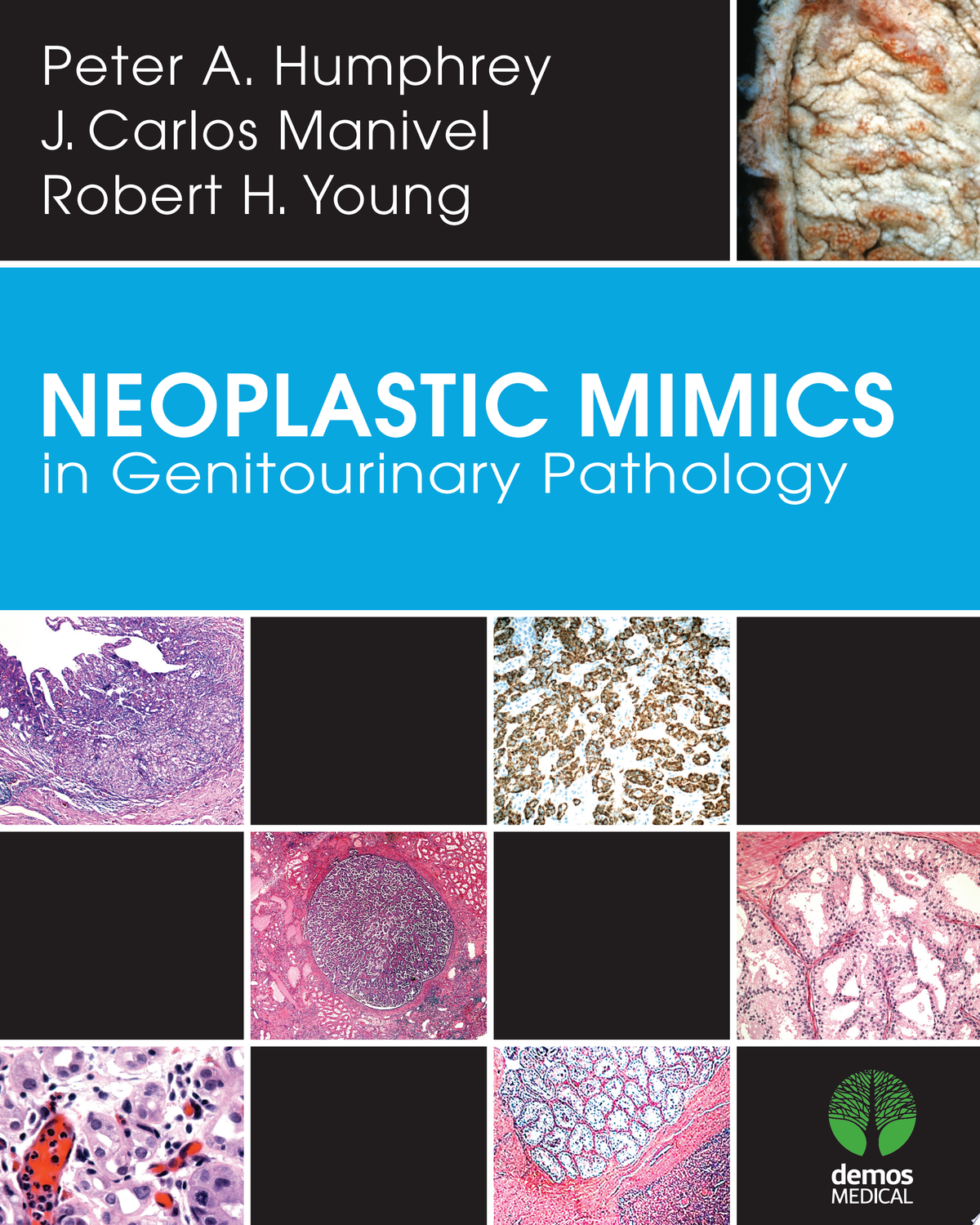 Neoplastic Mimics in Genitourinary Pathology
