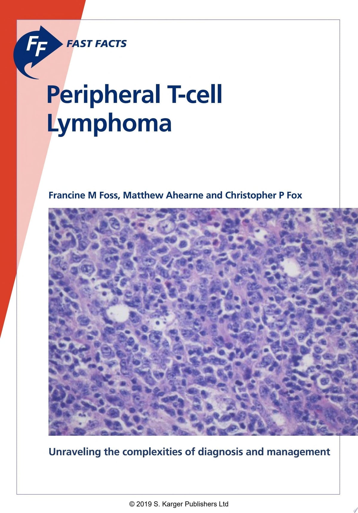 Fast Facts: Peripheral T-cell Lymphoma: Unraveling the complexities of diagnosis and management