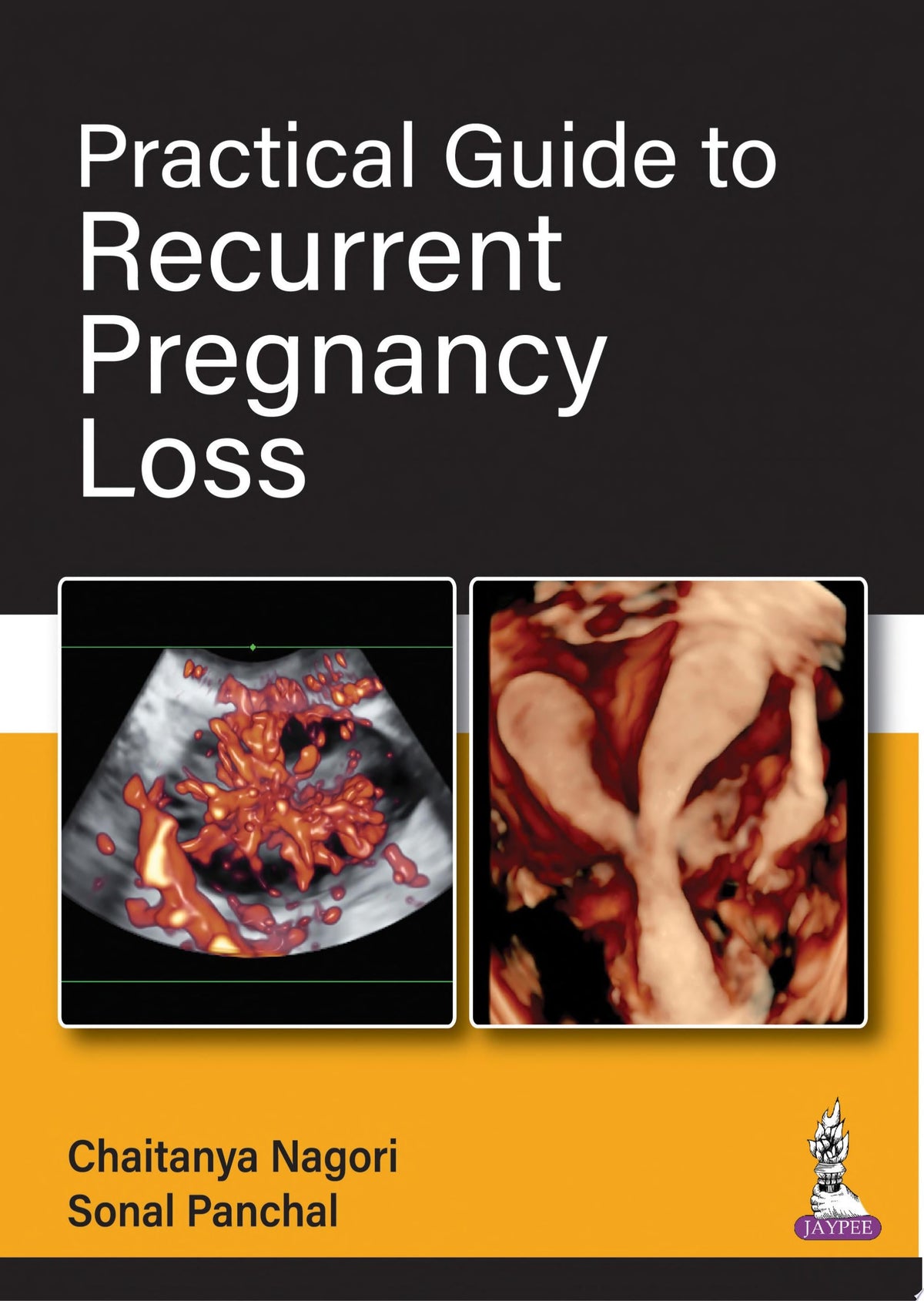Practical Guide to Recurrent Pregnancy Loss