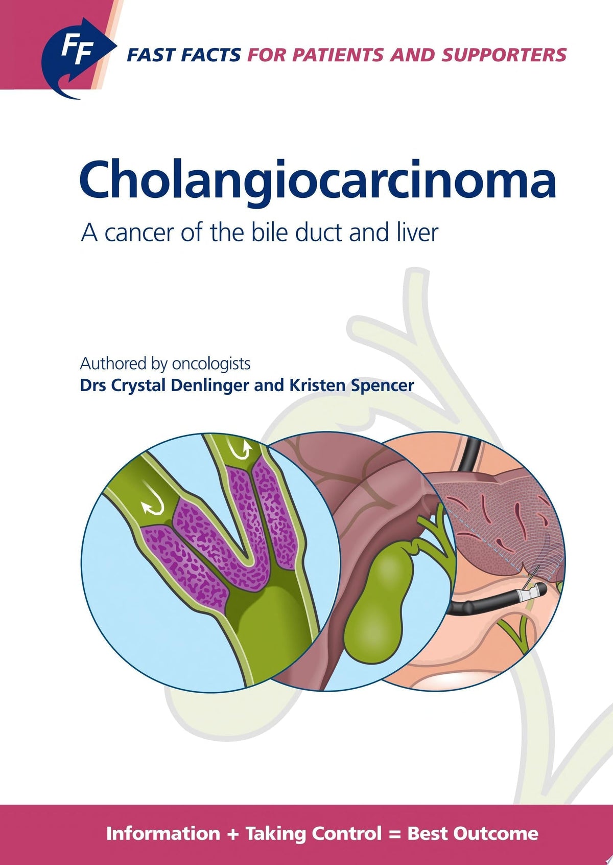 Fast Facts for Patients and Supporters: Cholangiocarcinoma